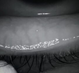 Meibomian Gland Expression at IQ Optometry